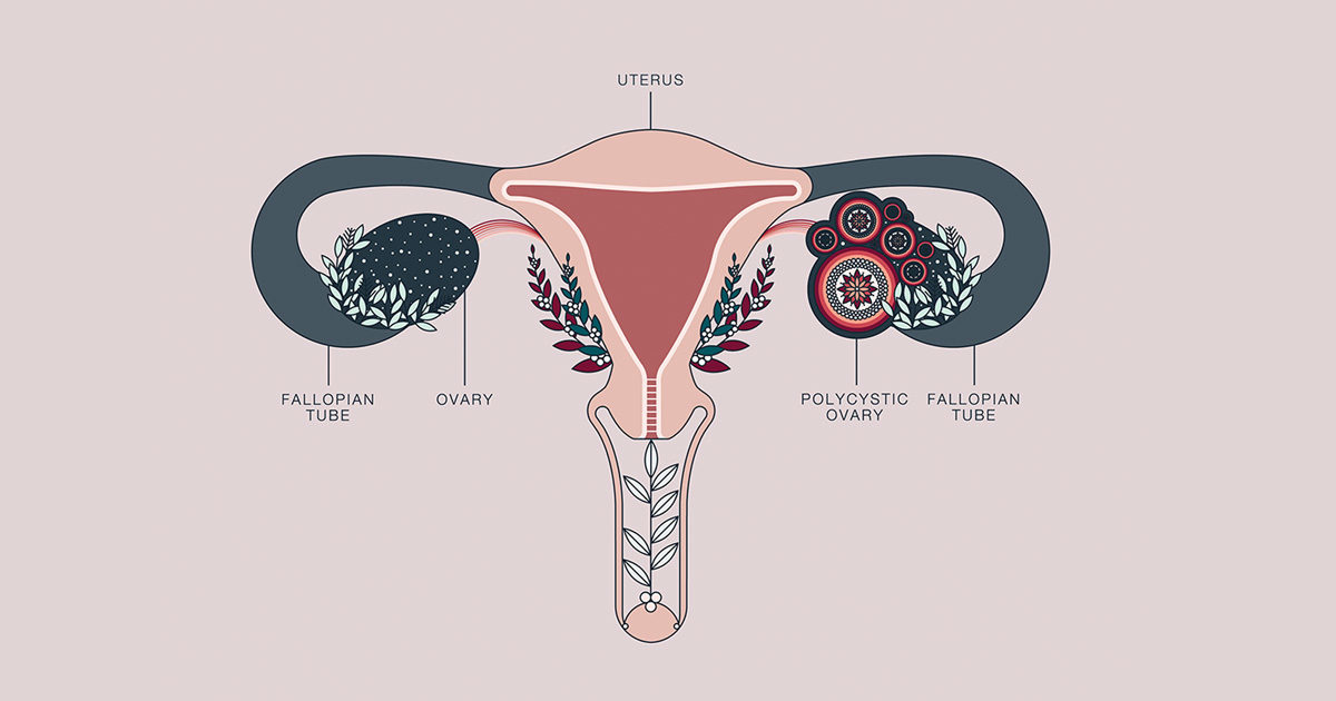 polycystic ovary syndrome infertility