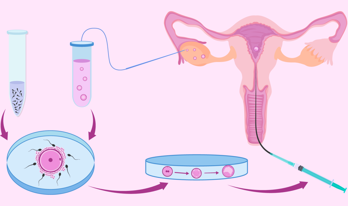 Tüp Bebek (IVF) Aşamaları