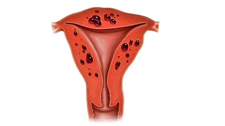 adenomyozis-nedir