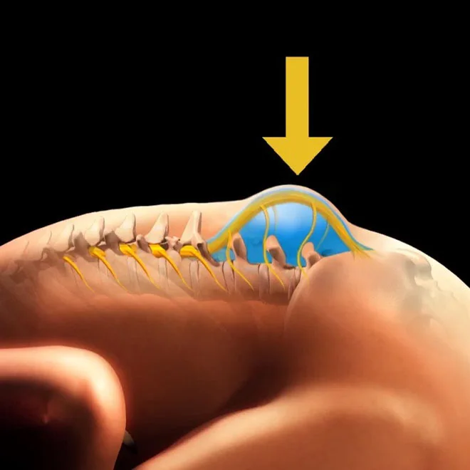 spina-bifida-neden-olur-1